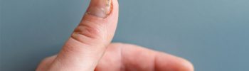Nagel Hand Hautkrebs