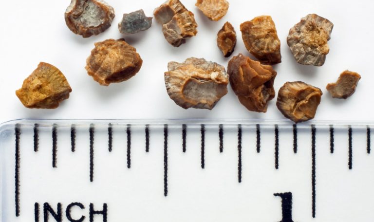 Größter Nierenstein der Welt entfernt