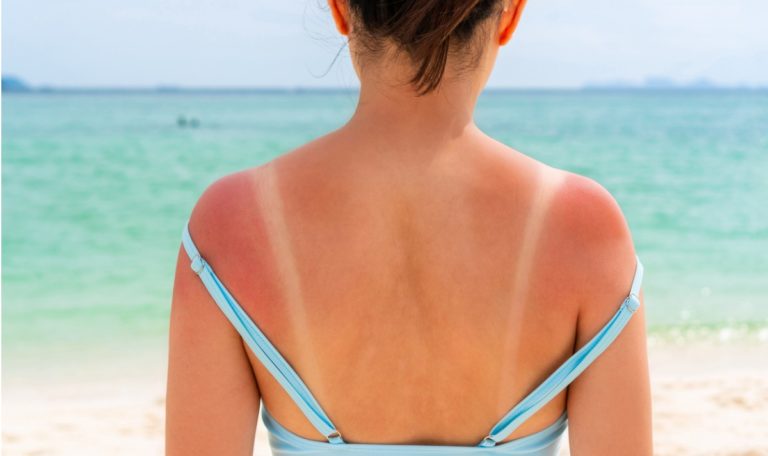 So entsteht Sonnenbrand und so heilt er schneller