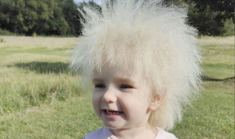 Struwwelpeter-Syndrom: Die Haare dieser Dreijährigen sind nicht zu bändigen