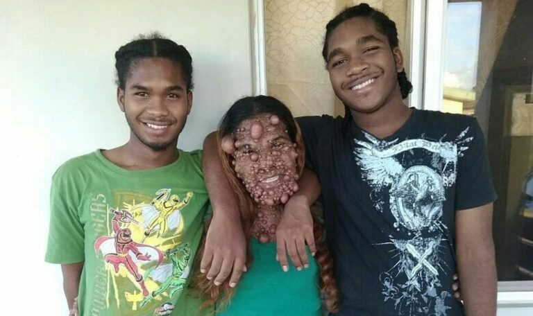 Tausende Tumore wegoperiert: SO sieht die Frau jetzt aus (FOTOS+VIDEO)