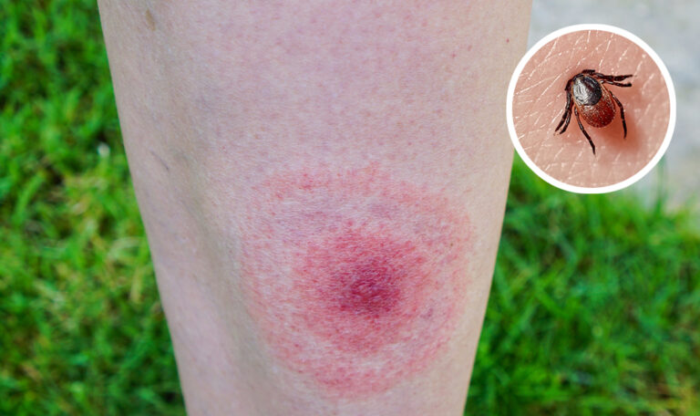 Übertragung durch Zecken: Durchbruch bei Borreliose-Impfstoff