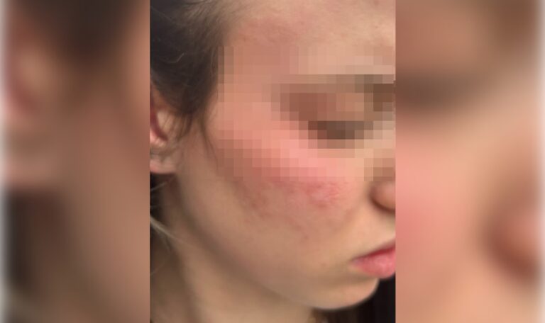 EXKLUSIV: Gewalt an Wiener Schule – Mädchen brutal geschlagen (FOTOS)