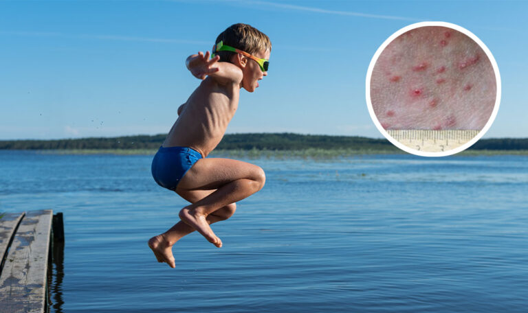Ausschlag-Gefahr: Hier musst du beim Baden aufpassen