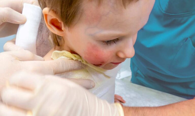 Brandverletzungen bei Kindern in Österreich häufen sich