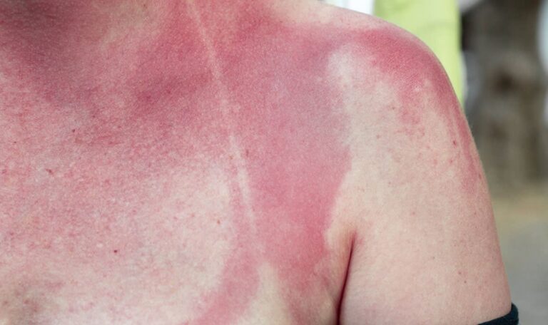 Feuerroter Rücken geheilt: Dieser Badezimmer-Trick verblüfft Hautärzte