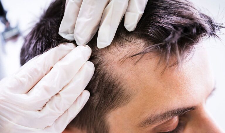 Männer-Alarm: Dieses Getränk verursacht Haarausfall!