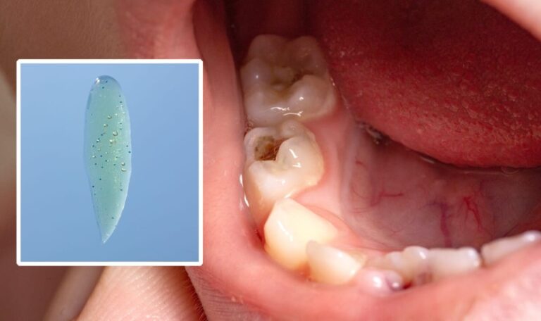 Durchbruch im Kampf gegen Löcher: Forscher entwickeln Wunder-Gel für Zähne