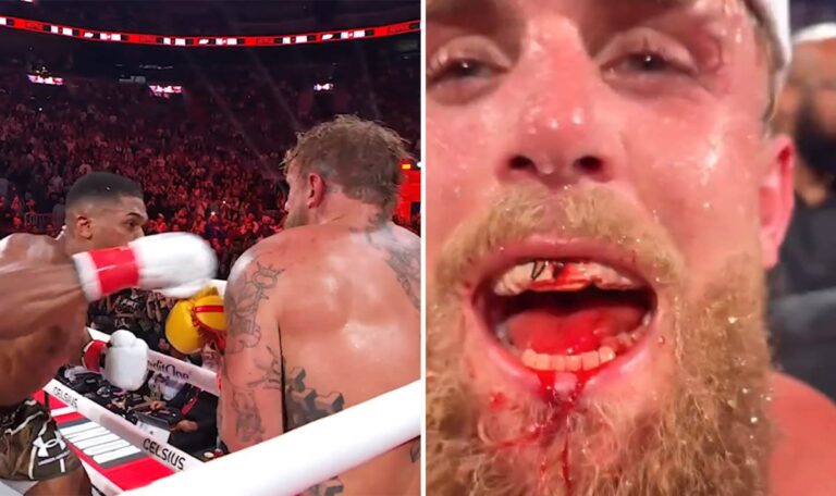 Titanplatten im Kiefer, Zähne entfernt: YouTuber Paul nach Knockout operiert