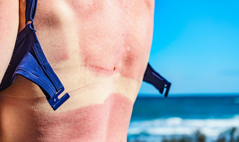 Sonnenstich und Hitzschlag: Erste Hilfe und Vorbeugung im Hochsommer