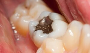 Amalgam-Aus: Warum müssen Patienten noch immer warten?