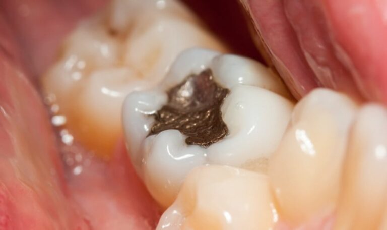 Amalgam-Aus: Warum müssen Patienten noch immer warten?